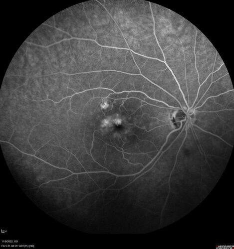 Pseudophakic CME chronic
74 year old man presented 14 weeks after cataract surgery with severe CME on topical therapy.  Multiple attempts to taper drops failed.  Also, the patient had a steroid responsive glaucoma.  He ended up on BID PF, Ketorolac and Dorz/Timolol
