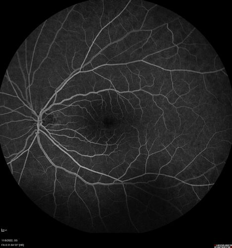 Pseudophakic CME chronic
74 year old man presented 14 weeks after cataract surgery with severe CME on topical therapy.  Multiple attempts to taper drops failed.  Also, the patient had a steroid responsive glaucoma.  He ended up on BID PF, Ketorolac and Dorz/Timolol
