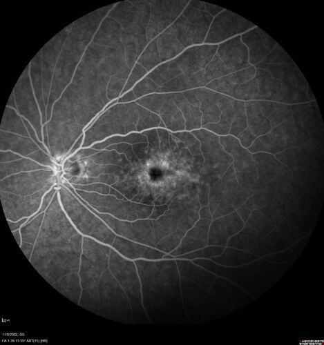 Pseudophakic CME chronic
74 year old man presented 14 weeks after cataract surgery with severe CME on topical therapy.  Multiple attempts to taper drops failed.  Also, the patient had a steroid responsive glaucoma.  He ended up on BID PF, Ketorolac and Dorz/Timolol
