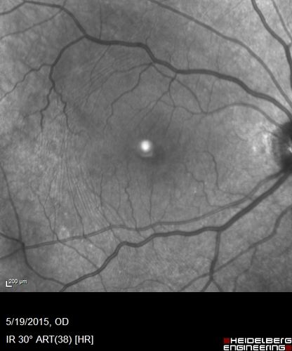 Pseudophakic Cystoid Macular Edema Both Eyes
81 year old man with vision loss about 4 months following ECCE.  Did not respond to topical therapy but did fine with PST kenalog
