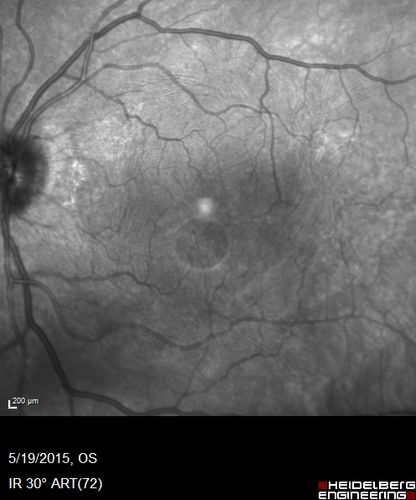 Pseudophakic Cystoid Macular Edema Both Eyes
81 year old man with vision loss about 4 months following ECCE.  Did not respond to topical therapy but did fine with PST kenalog

