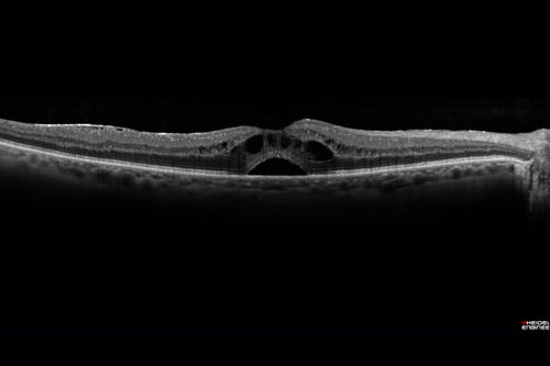 Pseudophakic Cystoid Macular Edema Both Eyes
81 year old man with vision loss about 4 months following ECCE.  Did not respond to topical therapy but did fine with PST kenalog

