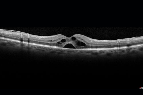 Pseudophakic Cystoid Macular Edema Both Eyes
81 year old man with vision loss about 4 months following ECCE.  Did not respond to topical therapy but did fine with PST kenalog
