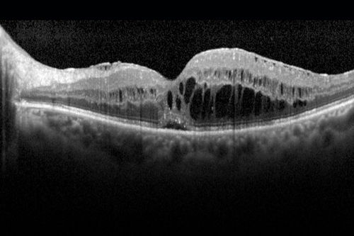 Pseudophakic Cystoid Macular Edema Both Eyes
81 year old man with vision loss about 4 months following ECCE.  Did not respond to topical therapy but did fine with PST kenalog
