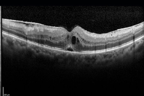 Pseudophakic Cystoid Macular Edema Both Eyes
81 year old man with vision loss about 4 months following ECCE.  Did not respond to topical therapy but did fine with PST kenalog
