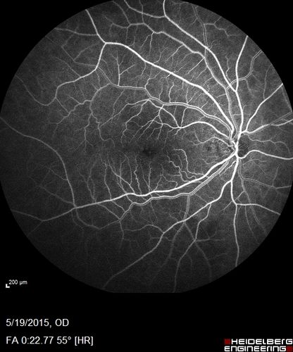 Pseudophakic Cystoid Macular Edema Both Eyes
81 year old man with vision loss about 4 months following ECCE.  Did not respond to topical therapy but did fine with PST kenalog
