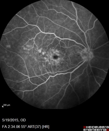 Pseudophakic Cystoid Macular Edema Both Eyes
81 year old man with vision loss about 4 months following ECCE.  Did not respond to topical therapy but did fine with PST kenalog
