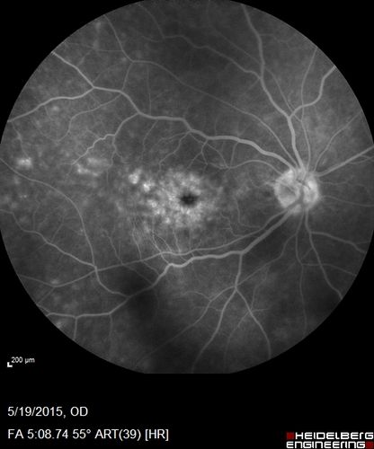 Pseudophakic Cystoid Macular Edema Both Eyes
81 year old man with vision loss about 4 months following ECCE.  Did not respond to topical therapy but did fine with PST kenalog
