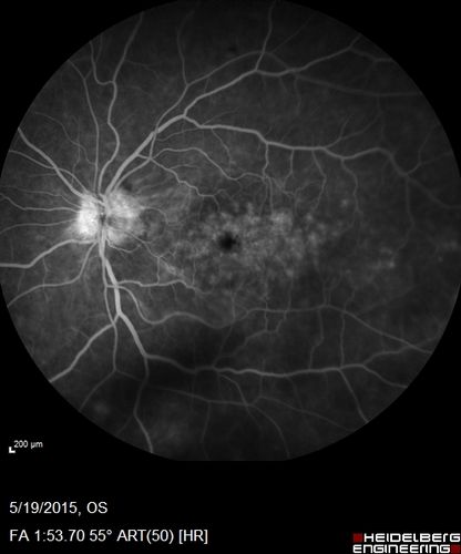 Pseudophakic Cystoid Macular Edema Both Eyes
81 year old man with vision loss about 4 months following ECCE.  Did not respond to topical therapy but did fine with PST kenalog
