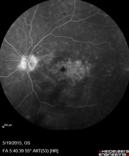 Pseudophakic Cystoid Macular Edema Both Eyes
81 year old man with vision loss about 4 months following ECCE.  Did not respond to topical therapy but did fine with PST kenalog
