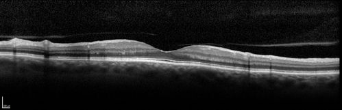 Cystoid Macular Edema 10 years after Cataract Surgery
No overt uveitis but the patient had aching in the eyes and responded to topical anti-inflammatory drops with recurrence of the CME on discontinuation of topical therapy
