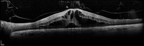 Cystoid Macular Edema 10 years after Cataract Surgery
No overt uveitis but the patient had aching in the eyes and responded to topical anti-inflammatory drops with recurrence of the CME on discontinuation of topical therapy
