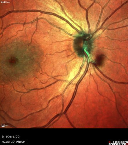 Cystoid Macular Edema following Cataract surgery and vitrectomy for floaters
73 year old woman who had decreased vision 4 months following combined vitrectomy and cataract surgery.  VA 20/63 improved in 1 month to 20/25 with ketorolac and prednisolone drops.

