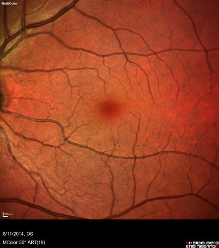 Cystoid Macular Edema following Cataract surgery and vitrectomy for floaters
73 year old woman who had decreased vision 4 months following combined vitrectomy and cataract surgery.  VA 20/63 improved in 1 month to 20/25 with ketorolac and prednisolone drops.
