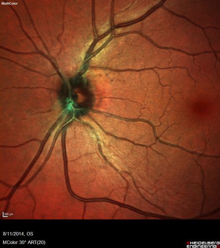 Cystoid Macular Edema following Cataract surgery and vitrectomy for floaters
73 year old woman who had decreased vision 4 months following combined vitrectomy and cataract surgery.  VA 20/63 improved in 1 month to 20/25 with ketorolac and prednisolone drops.
