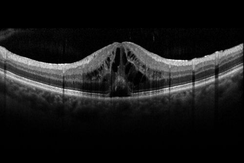 Cystoid Macular Edema following Cataract surgery and vitrectomy for floaters
73 year old woman who had decreased vision 4 months following combined vitrectomy and cataract surgery.  VA 20/63 improved in 1 month to 20/25 with ketorolac and prednisolone drops.
