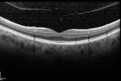 Cystoid Macular Edema following Cataract surgery and vitrectomy for floaters
73 year old woman who had decreased vision 4 months following combined vitrectomy and cataract surgery.  VA 20/63 improved in 1 month to 20/25 with ketorolac and prednisolone drops.

