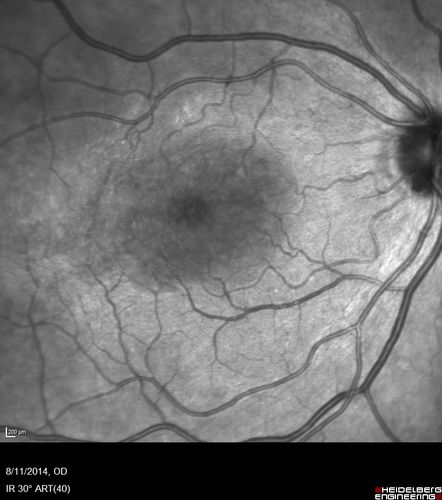 Cystoid Macular Edema following Cataract surgery and vitrectomy for floaters
73 year old woman who had decreased vision 4 months following combined vitrectomy and cataract surgery.  VA 20/63 improved in 1 month to 20/25 with ketorolac and prednisolone drops.
