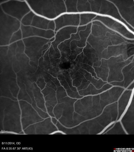 Cystoid Macular Edema following Cataract surgery and vitrectomy for floaters
73 year old woman who had decreased vision 4 months following combined vitrectomy and cataract surgery.  VA 20/63 improved in 1 month to 20/25 with ketorolac and prednisolone drops.
