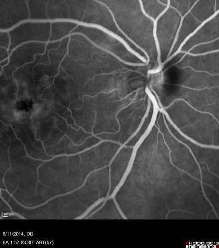 Cystoid Macular Edema following Cataract surgery and vitrectomy for floaters
73 year old woman who had decreased vision 4 months following combined vitrectomy and cataract surgery.  VA 20/63 improved in 1 month to 20/25 with ketorolac and prednisolone drops.
