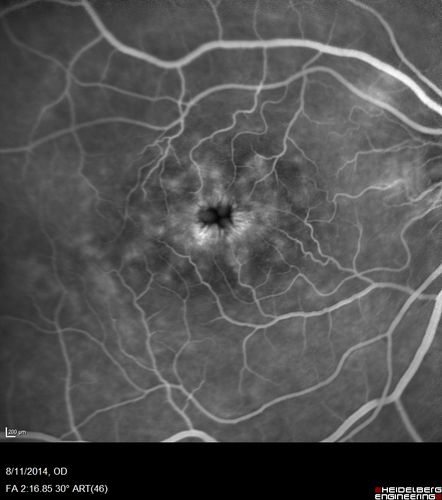 Cystoid Macular Edema following Cataract surgery and vitrectomy for floaters
73 year old woman who had decreased vision 4 months following combined vitrectomy and cataract surgery.  VA 20/63 improved in 1 month to 20/25 with ketorolac and prednisolone drops.
