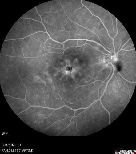 Cystoid Macular Edema following Cataract surgery and vitrectomy for floaters
73 year old woman who had decreased vision 4 months following combined vitrectomy and cataract surgery.  VA 20/63 improved in 1 month to 20/25 with ketorolac and prednisolone drops.
