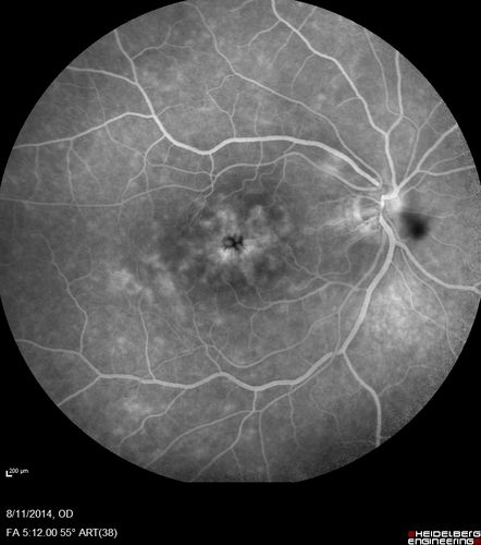 Cystoid Macular Edema following Cataract surgery and vitrectomy for floaters
73 year old woman who had decreased vision 4 months following combined vitrectomy and cataract surgery.  VA 20/63 improved in 1 month to 20/25 with ketorolac and prednisolone drops.
