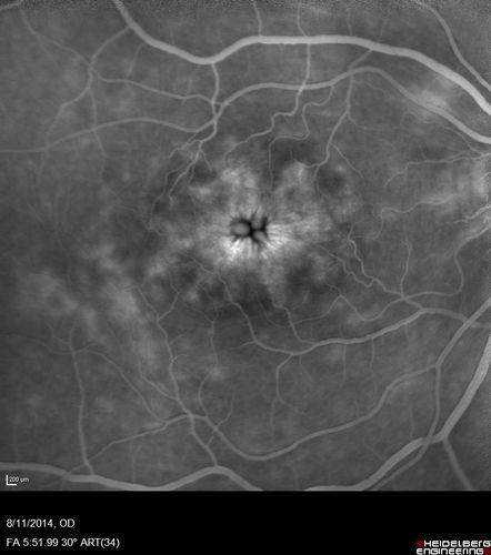Cystoid Macular Edema following Cataract surgery and vitrectomy for floaters
73 year old woman who had decreased vision 4 months following combined vitrectomy and cataract surgery.  VA 20/63 improved in 1 month to 20/25 with ketorolac and prednisolone drops.

