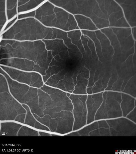 Cystoid Macular Edema following Cataract surgery and vitrectomy for floaters
73 year old woman who had decreased vision 4 months following combined vitrectomy and cataract surgery.  VA 20/63 improved in 1 month to 20/25 with ketorolac and prednisolone drops.
