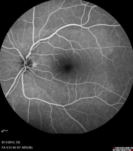 Cystoid Macular Edema following Cataract surgery and vitrectomy for floaters
73 year old woman who had decreased vision 4 months following combined vitrectomy and cataract surgery.  VA 20/63 improved in 1 month to 20/25 with ketorolac and prednisolone drops.
