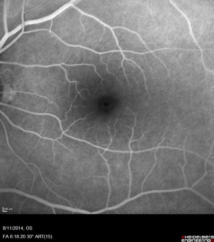 Cystoid Macular Edema following Cataract surgery and vitrectomy for floaters
73 year old woman who had decreased vision 4 months following combined vitrectomy and cataract surgery.  VA 20/63 improved in 1 month to 20/25 with ketorolac and prednisolone drops.
