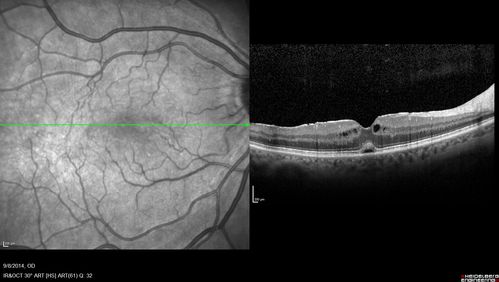 Cystoid Macular Edema following Cataract surgery and vitrectomy for floaters
73 year old woman who had decreased vision 4 months following combined vitrectomy and cataract surgery.  VA 20/63 improved in 1 month to 20/25 with ketorolac and prednisolone drops.
