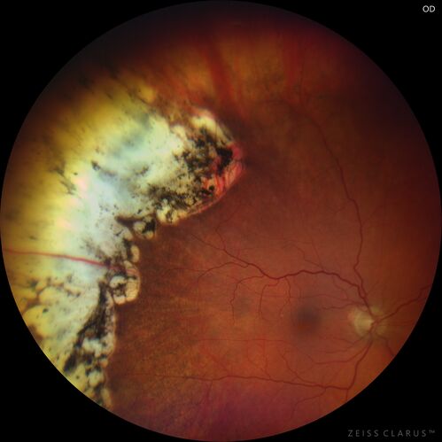 Macular edema from latanaprost
79 year old man with macula off RD repair 15 years ago and cataract surgery 14 years ago with new CME.  Patient recently started on latanaprost  VA 20/100 OD
