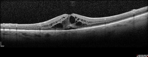 Macular edema from latanaprost
79 year old man with macula off RD repair 15 years ago and cataract surgery 14 years ago with new CME.  Patient recently started on latanaprost  VA 20/100 OD
