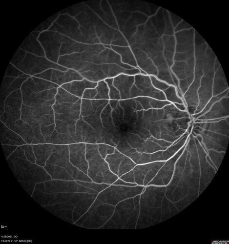 Macular edema from latanaprost
79 year old man with macula off RD repair 15 years ago and cataract surgery 14 years ago with new CME.  Patient recently started on latanaprost  VA 20/100 OD
