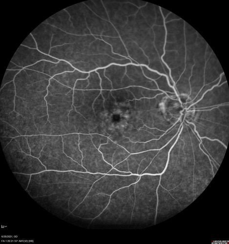 Macular edema from latanaprost
79 year old man with macula off RD repair 15 years ago and cataract surgery 14 years ago with new CME.  Patient recently started on latanaprost  VA 20/100 OD
