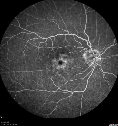 Macular edema from latanaprost
79 year old man with macula off RD repair 15 years ago and cataract surgery 14 years ago with new CME.  Patient recently started on latanaprost  VA 20/100 OD
