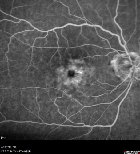 Macular edema from latanaprost
79 year old man with macula off RD repair 15 years ago and cataract surgery 14 years ago with new CME.  Patient recently started on latanaprost  VA 20/100 OD
