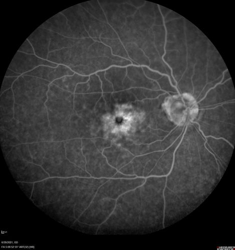 Macular edema from latanaprost
79 year old man with macula off RD repair 15 years ago and cataract surgery 14 years ago with new CME.  Patient recently started on latanaprost  VA 20/100 OD

