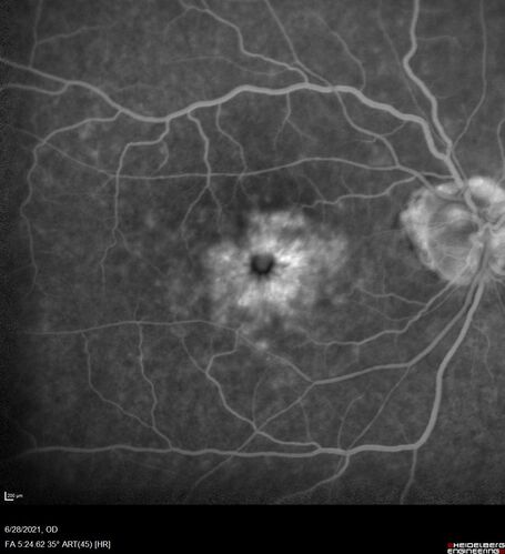 Macular edema from latanaprost
79 year old man with macula off RD repair 15 years ago and cataract surgery 14 years ago with new CME.  Patient recently started on latanaprost  VA 20/100 OD
