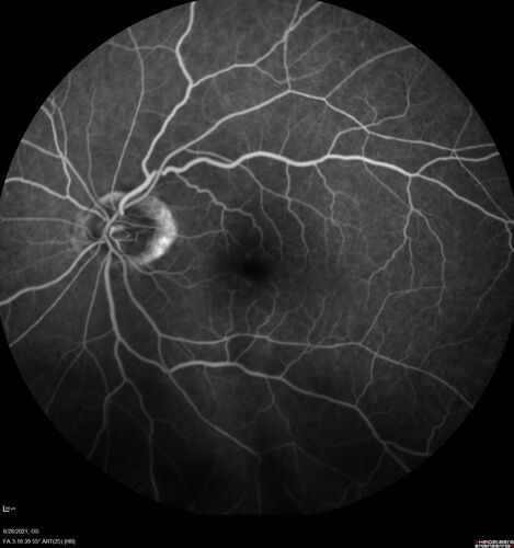 Macular edema from latanaprost
79 year old man with macula off RD repair 15 years ago and cataract surgery 14 years ago with new CME.  Patient recently started on latanaprost  VA 20/100 OD
