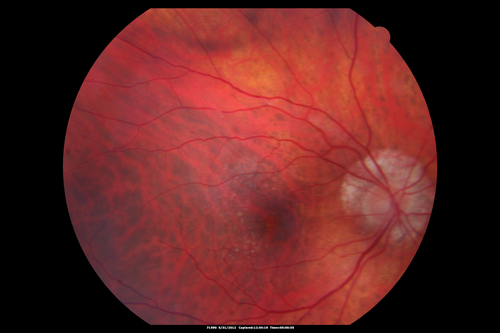 Lumigan (Bimatoprost) Cystoid Macular Edema - Eye Better 1 month after Stopping Lumigan
