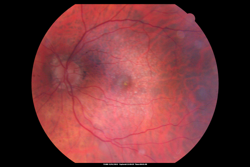 Lumigan (Bimatoprost) Cystoid Macular Edema - Eye Better 1 month after Stopping Lumigan
 82-year-old man had cataract surgery in 1993.  He has had glaucoma for seven or eight years for a long time.  He is taking Lumigan only in the left eye.  About a year ago he started in the right eye and then starting just about a few months ago he has noticed intermittent blurring in the vision in the right eye. Vision 20/25 OD, 20/20 OS
