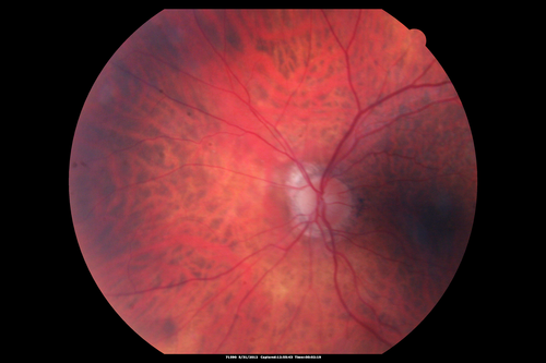 Lumigan (Bimatoprost) Cystoid Macular Edema - Eye Better 1 month after Stopping Lumigan
 82-year-old man had cataract surgery in 1993.  He has had glaucoma for seven or eight years for a long time.  He is taking Lumigan only in the left eye.  About a year ago he started in the right eye and then starting just about a few months ago he has noticed intermittent blurring in the vision in the right eye. Vision 20/25 OD, 20/20 OS
