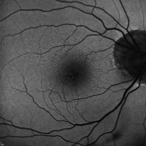 Lumigan (Bimatoprost) Cystoid Macular Edema - Eye Better 1 month after Stopping Lumigan
 82-year-old man had cataract surgery in 1993.  He has had glaucoma for seven or eight years for a long time.  He is taking Lumigan only in the left eye.  About a year ago he started in the right eye and then starting just about a few months ago he has noticed intermittent blurring in the vision in the right eye. Vision 20/25 OD, 20/20 OS

