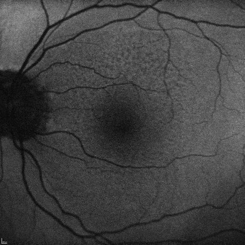 Lumigan (Bimatoprost) Cystoid Macular Edema - Eye Better 1 month after Stopping Lumigan
 82-year-old man had cataract surgery in 1993.  He has had glaucoma for seven or eight years for a long time.  He is taking Lumigan only in the left eye.  About a year ago he started in the right eye and then starting just about a few months ago he has noticed intermittent blurring in the vision in the right eye. Vision 20/25 OD, 20/20 OS
