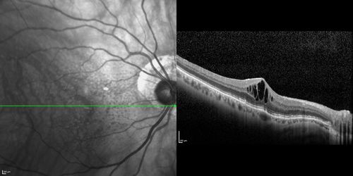 Lumigan (Bimatoprost) Cystoid Macular Edema - Eye Better 1 month after Stopping Lumigan
 82-year-old man had cataract surgery in 1993.  He has had glaucoma for seven or eight years for a long time.  He is taking Lumigan only in the left eye.  About a year ago he started in the right eye and then starting just about a few months ago he has noticed intermittent blurring in the vision in the right eye. Vision 20/25 OD, 20/20 OS
