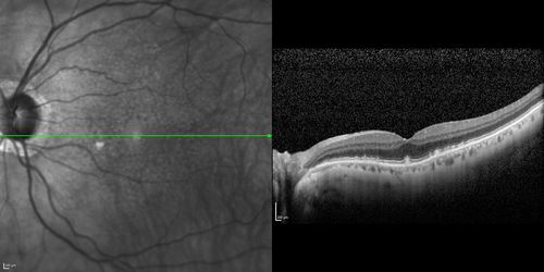 Lumigan (Bimatoprost) Cystoid Macular Edema - Eye Better 1 month after Stopping Lumigan
 82-year-old man had cataract surgery in 1993.  He has had glaucoma for seven or eight years for a long time.  He is taking Lumigan only in the left eye.  About a year ago he started in the right eye and then starting just about a few months ago he has noticed intermittent blurring in the vision in the right eye. Vision 20/25 OD, 20/20 OS

