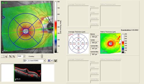 Lumigan (Bimatoprost) Cystoid Macular Edema - Eye Better 1 month after Stopping Lumigan
 82-year-old man had cataract surgery in 1993.  He has had glaucoma for seven or eight years for a long time.  He is taking Lumigan only in the left eye.  About a year ago he started in the right eye and then starting just about a few months ago he has noticed intermittent blurring in the vision in the right eye. Vision 20/25 OD, 20/20 OS
