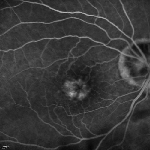  82-year-old man had cataract surgery in 1993.  He has had glaucoma for seven or eight years for a long time.  He is taking Lumigan only in the left eye.  About a year ago he started in the right eye and then starting just about a few months ago he has noticed intermittent blurring in the vision in the right eye. Vision 20/25 OD, 20/20 OS

